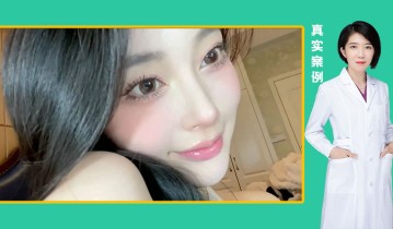 黄金媚眼重睑术效果【2】