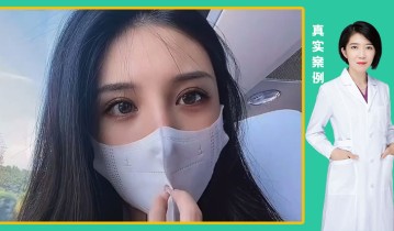 孙雅楠医生-黄金媚眼重睑术效果