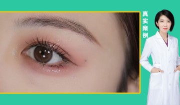 孙雅楠医生-眼综合双眼皮效果