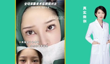 全切双眼皮术后即可对比